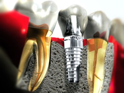 Tijuana dental implant - www.dentaltourismnewsco.blogspot.com